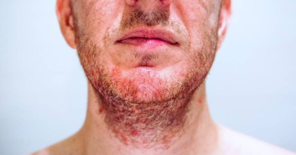 Dermatite seborroica: come affrontarla con successo? Dermatite seborroica: come affrontarla con successo?