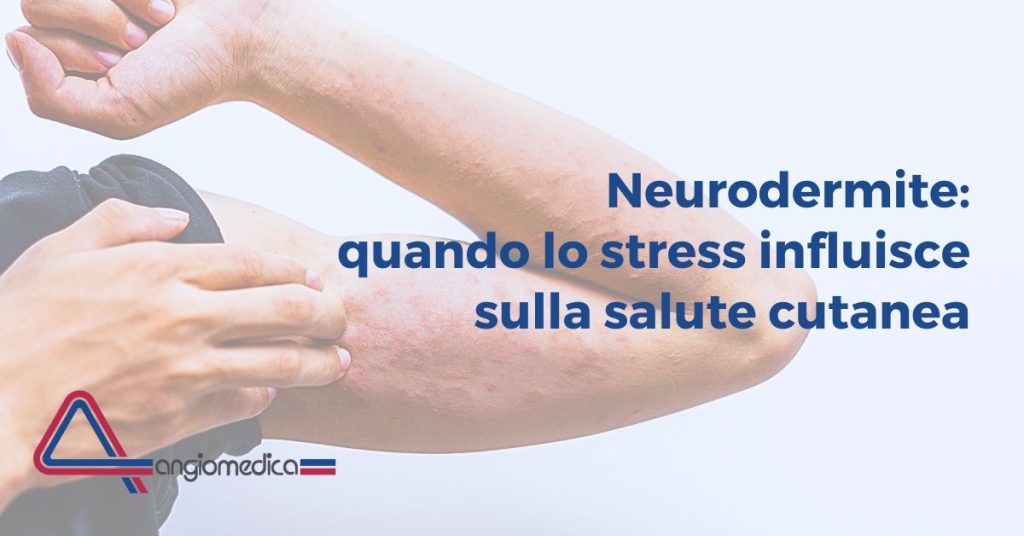 Neurodermite: come affrontare la dermatite da stress Persona con evidente rossore e desquamazione sul braccio. In sovraimpressione si legge: Neurodermite: quando lo stress influisce sulla salute cutanea