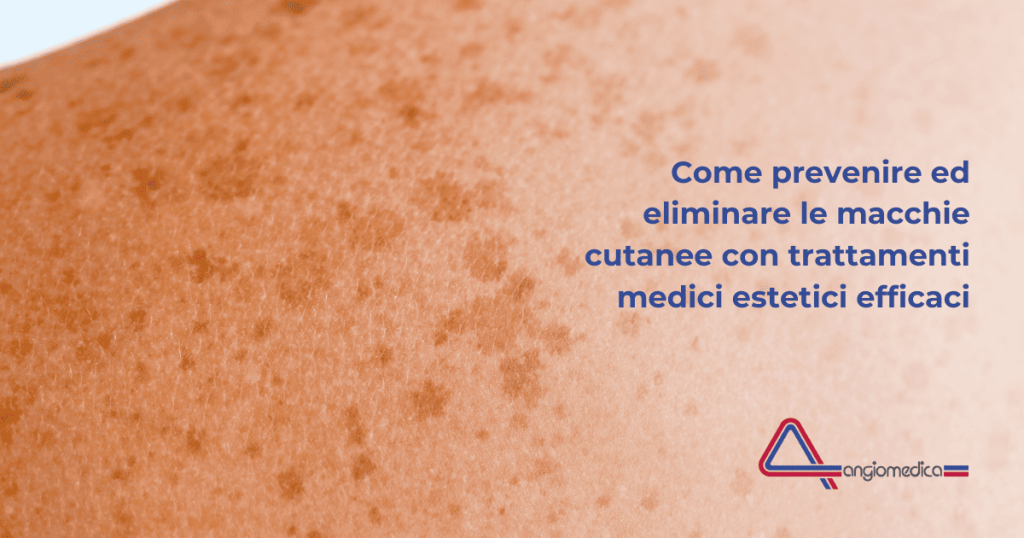 Eliminare le macchie solari: peeling e laser a confronto Eliminare le macchie solari: peeling e laser a confronto