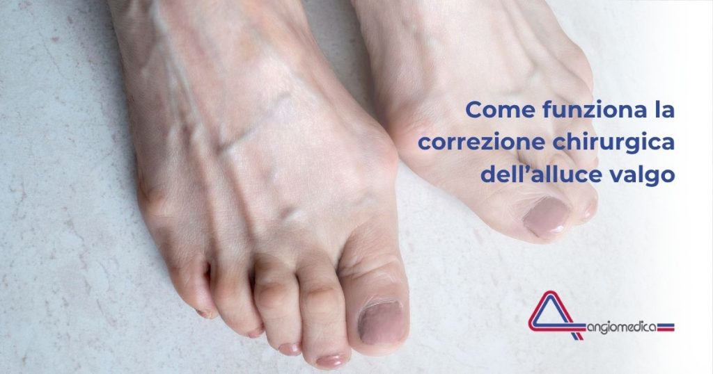 Intervento alluce valgo: quando farlo, come funziona e cosa aspettarsi Intervento alluce valgo: quando farlo, come funziona e cosa aspettarsi