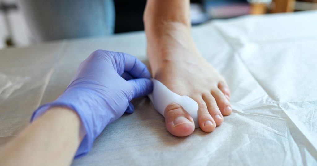 Intervento alluce valgo: quando farlo, come funziona e cosa aspettarsi